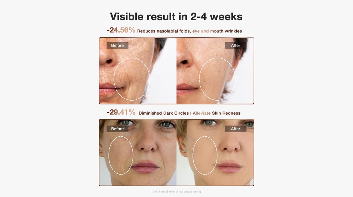 Jovs 4D Laser Light Therapy Mask